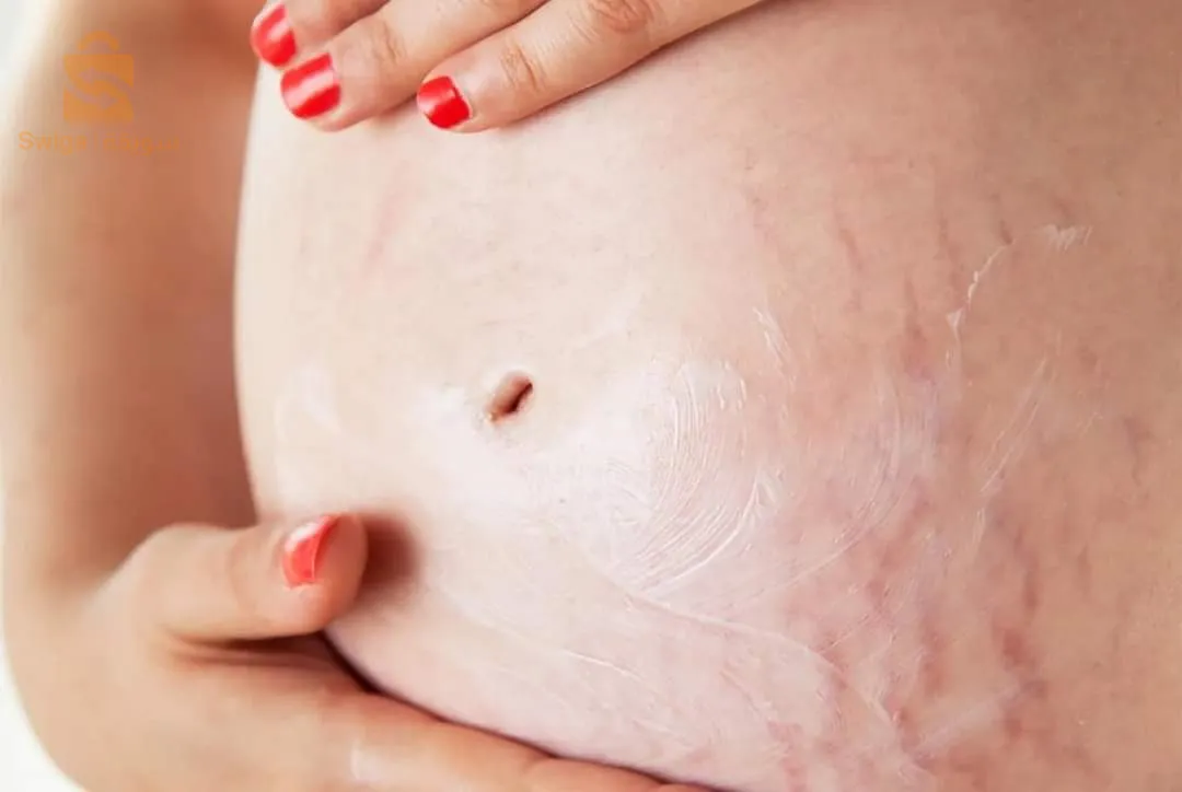 Crème vergetures grossesse