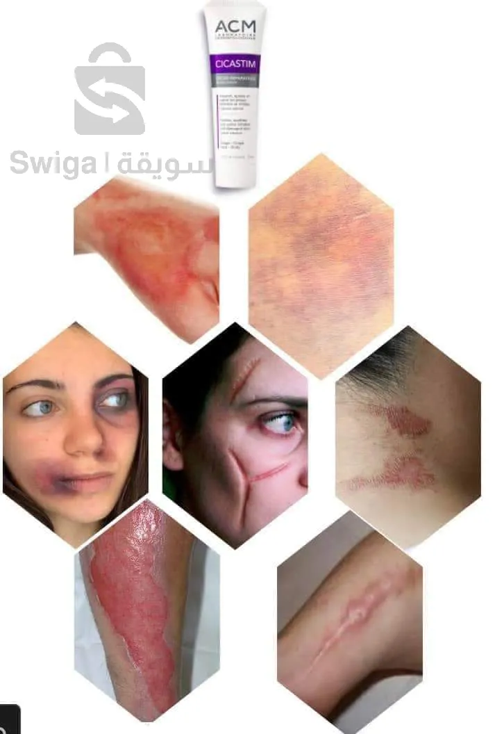 Acm cicastim gel