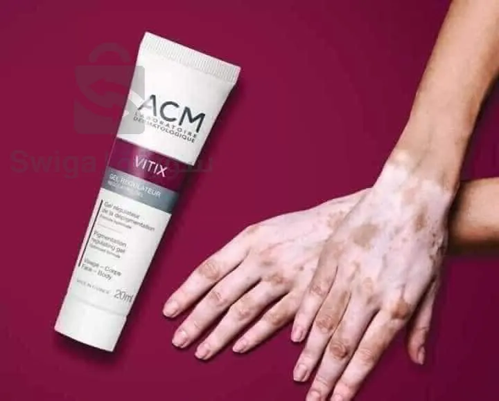 كريمة لعلاج البهاق