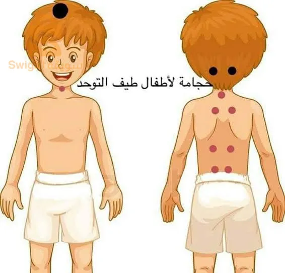 دورة تعليمية في الحجامة