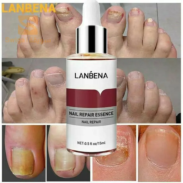 Le sérum de réparation des ongles LANBENA traite les champignons élimine la desquamation et la desquamation des ongles, des soins des mains et des pieds