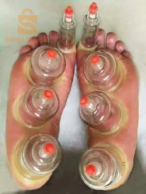 دورة تعليمية في الحجامة