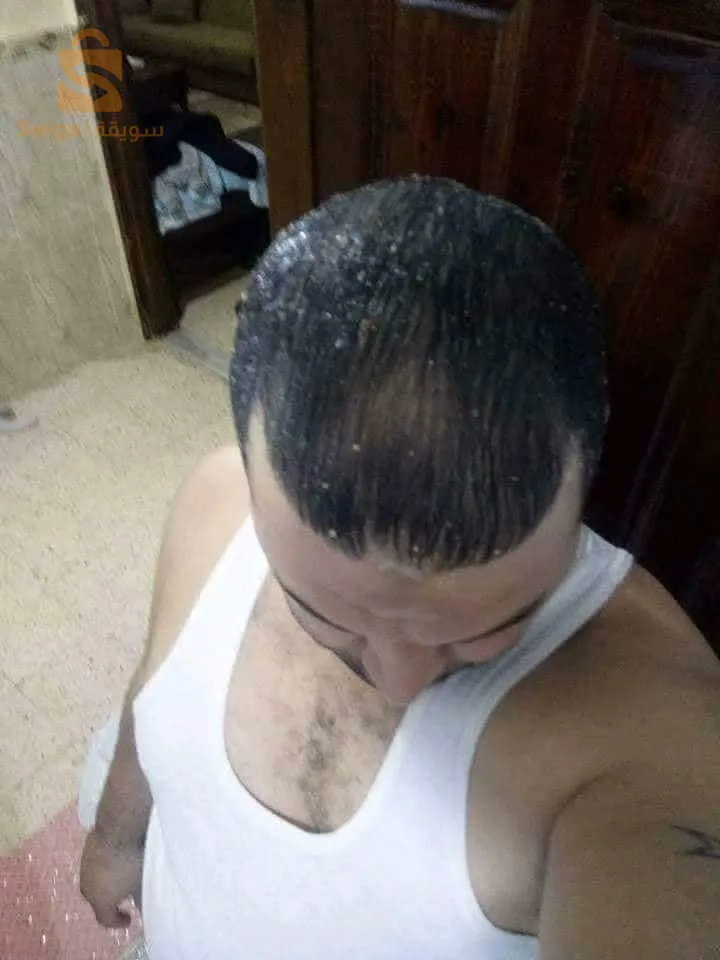منتوج طبيعي 100% لتقوية الشعر والحد من تساقطه في وقت وجيز