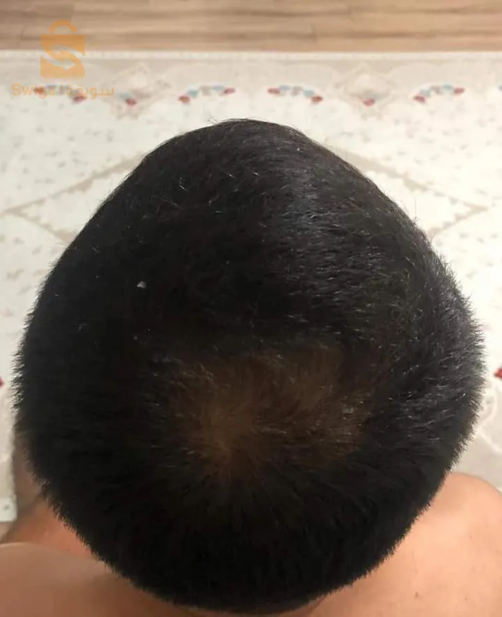 منتوج طبيعي 100% لتقوية الشعر والحد من تساقطه في وقت وجيز