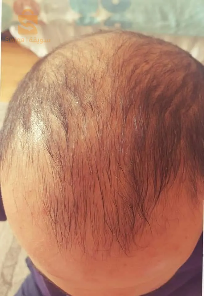 منتوج طبيعي 100% لتقوية الشعر والحد من تساقطه في وقت وجيز