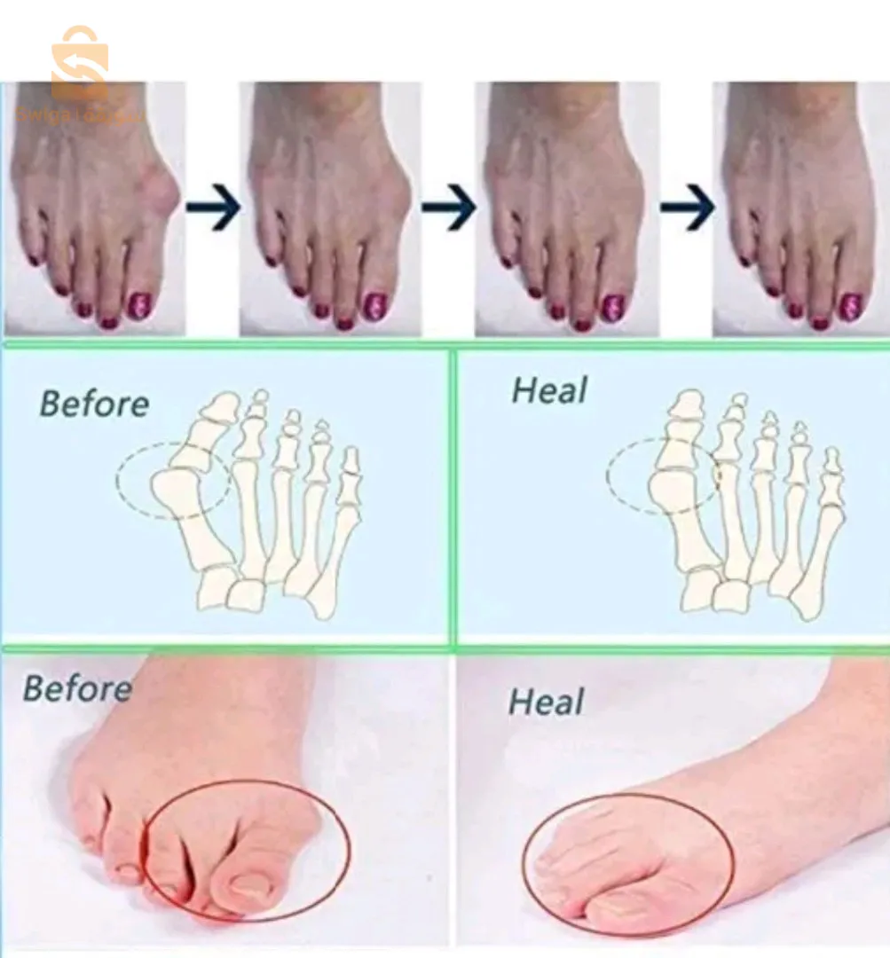 مصحح أصابع القدم