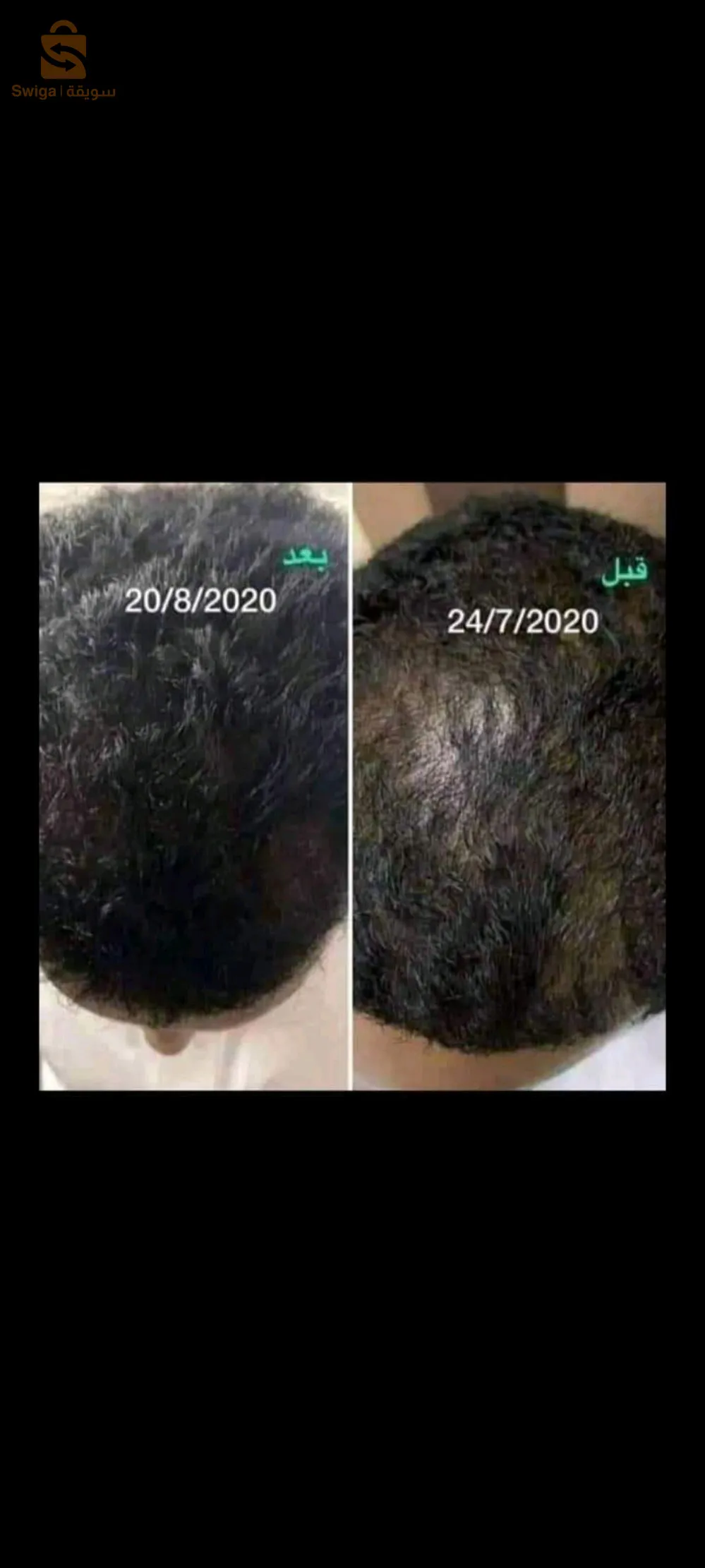 الزيت السحري لتنبيت الشعر وملء الفراغات غني بالفيتامينات والبروتينات التي تحتاج لها فروه الراس