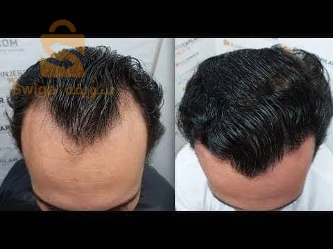 بخاخ المينوكسيديل تركيز 5%