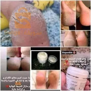 كريم تشقق الأقدام