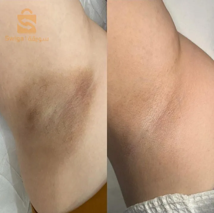 صابونة الكركم لعلاج مشاكل البشرة