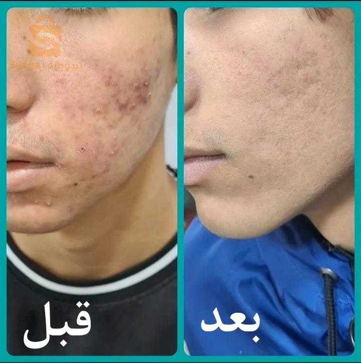 صابونة الكركم لعلاج مشاكل البشرة