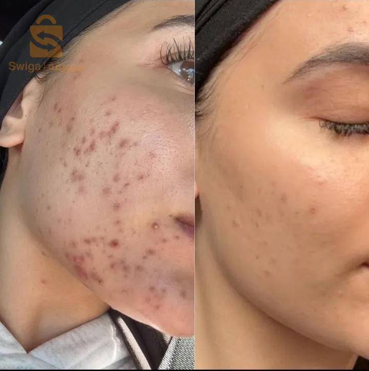 صابونة الكركم لعلاج مشاكل البشرة
