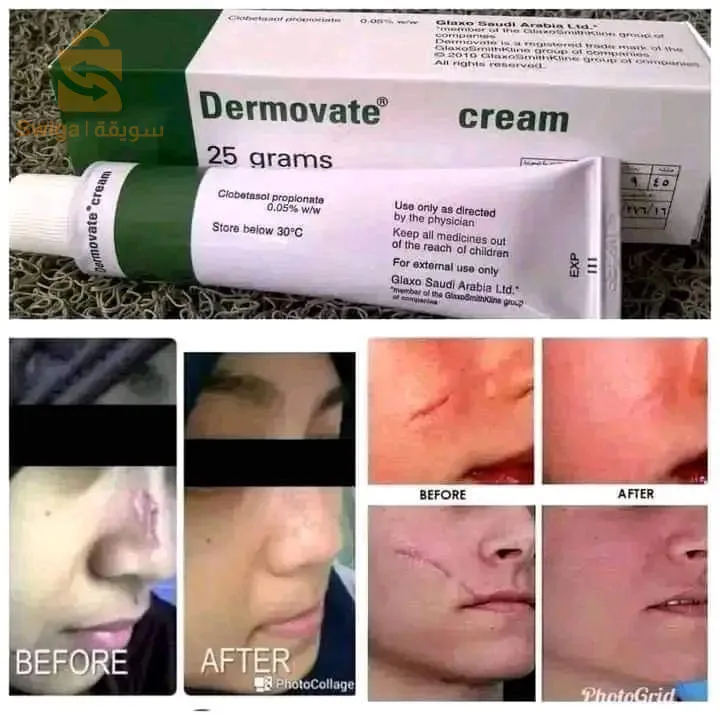 فرمادة للحكة