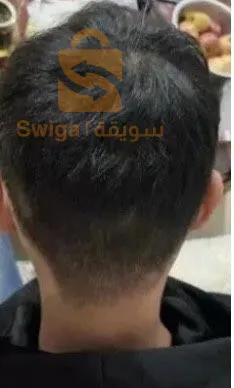 القضاء على الصلع الوراثي و الفراغات فالشعر و داء الثعلبة و فراغ فاللحية