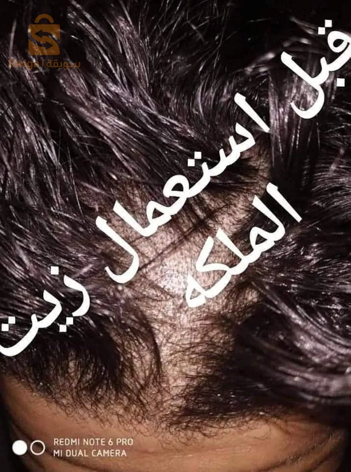 زيت الملكة لمشاكل الشعر