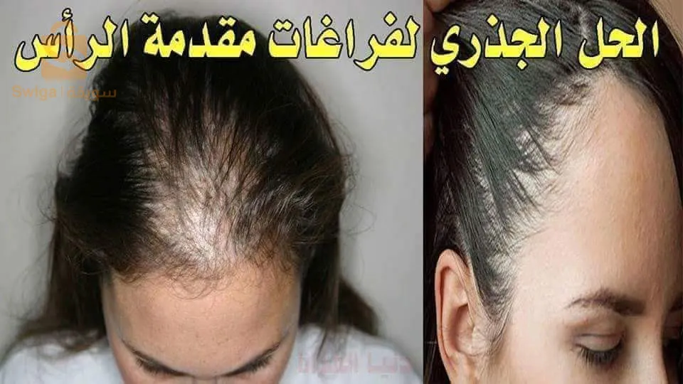زيت الملكة لمشاكل الشعر