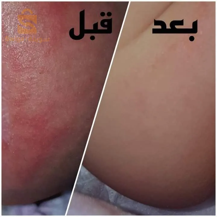 تخفيضات للمنتجات 
🌹 تخفيضات شهر جوان و عيد الأضحى المبارك 🌹

تبدأ التخفيضات اليوم وتنتهي يوم 15جوان ان شاء الله  🎉

نبداو بسم الله 

🌱منتجات البشرة الجافة: 
🎉سيروم الوجه للبشرة الجافة 500دج 
🎉كريمة مرطبة للبشرة الجافة 1200دج 
🎉كريمة نهارية للبشرة الجافة 1200دج 
🎉كريمة الهيالورونيك 1990دج 
🎉سيروم الهيالورونيك 1500دج 

🌱منتجات البشرة الدهنية والمختلطة:
🎉سيروم الوجه للبشرة الدهنية  والمختلطة ضد حب 550دج الشباب
🎉كريمة الحبة السوداء المضادة لحب الشباب 1800دج 
🎉غسول منظف للبشرة الدهنية والمختلطة بحمض الساليسيليك 1800دج 
🎉كريمة نهارية للبشرة الدهنية 1490دج 
🎉كريمة مرطبة للبشرة الدهنية والمختلطة 1490دج 
🎉سيروم النياسيناميد 1500دج 
🎉سيروم التقشير AHA bha 1600 

🌱منتجات الأطفال: 
🎉سيروم الأطفال 1300دج
🎉شامبو الأطفال 1200دج 
🎉كريمة التسلخات للرضع 1200دج 

🌱منتجات توحيد لون البشرة 
🎉سيروم فيتامين سي 1100دج
🎉كريمة الجزر 1000دج 

🌱منتجات تساقط الشعر:
🎉سيروم الشعر ضد التساقط 1400دج
🎉شامبو إكليل الجبل ضد تساقط الشعر 1500دج 
🎉بلسم التساقط 1500دج 

🌱منتجات الشعر التالف والمتقصف:
🎉شامبو الكيراتين 1650دج 
🎉بلسم الكيراتين 1500دج 
🎉ماسك الشعر التالف 1650دج 
🎉ماسك الشعر المرطب والمغذي (البوتوكس الطبيعي)  150غ 2300دج / 120غ 2200دج 
🎉زيت تطويل الشعر 2000دج 

منتجات الرجال:
🎉سيروم اللحية 30مل 1100دج 
🎉سيروم اللحية 10مل 390 دج

🌱 بوكس حمام دزاير 
🎉"صابون دزاير +ماء الورد 150مل+ تبريمة 50غ" 1650دج 

🌱منتجات العناية بالعيون:
🎉كريمة العيون ضد الهالات السوداء 500دج 
🎉سيروم تطويل الرموش 3مل 350دج 

🎉مشط مربع بدون اسم  1000دج

🌱منتجات العناية بالشفاه: 

🎉مرطبات الشفاه بذوق الفراولة وذوق التوت 400دج "للواحد" 

🎉مقشر الشفاه 100دج 

🎉كريمة الفطريات 1000دج 

🌱منتجات تنظيف البشرة:
🎉ماسك الكولاجان 450دج
🎉ماسك النيلة 400دج
🎉مقشر حمض الفواكه 450 دج
🎉صابون حليب الماعز 
150/200/500دج
🎉صابون النيلة الزرقاء 
200/450دج

 🌱منتجات ترطيب وتعطير الجسم :
🎉حليب الجسم 1100دج
🎉مخمرية الوردة البيضاء/good girl / my way
 400 دج 
🎉مزيل رائحة العرق بالليمون 550دج 

🎉مزيل رائحة العرق للحوامل 550دج 

🌱منتجات العناية بالأقدام:
🎉أملاح الاستحمام 200 دج
🎉مبرد الاقدام 480 دج
🎉 بوكس الأقدام (مبرد+أملاح الاستحمام +مورد الأقدام ) 750دج 

🌱منتجات العناية بالفم والاسنان:

🎉فحم تبييض الأسنان 200دج
🎉معجون الأسنان 750دج
🎉فرشاة أسنان 450دج
🎉غسول منظف للفم 350 دج

🌱المشط خشبي والمنتجات Personnalisés : 

🎉مشط خشبي مربع/بيضوي بالاسم: 1150دج 
🎉فرشاة أسنان بالاسم 450دج 
🎉مشط لحية 500دج 
🎉حافظة نقود بالاسم1400دج 
🎉مشط خشبي للأطفال بالاسم  1000دج 
🎉حافظة نقود نسائية 1400دج

توصيل متوفر ل 58ولاية والدفع عند الاستلام . 

ملاحظة: 
الكمية كالعادة ماشي محدودة بصح تنفذ بسرعة لانو بزاف لي يستنا كل شهر باش ياخذو وش خصهم لهاذا لي تحب دير طلبية ديرها فالأيام الأولى من التخفيضات 🌹