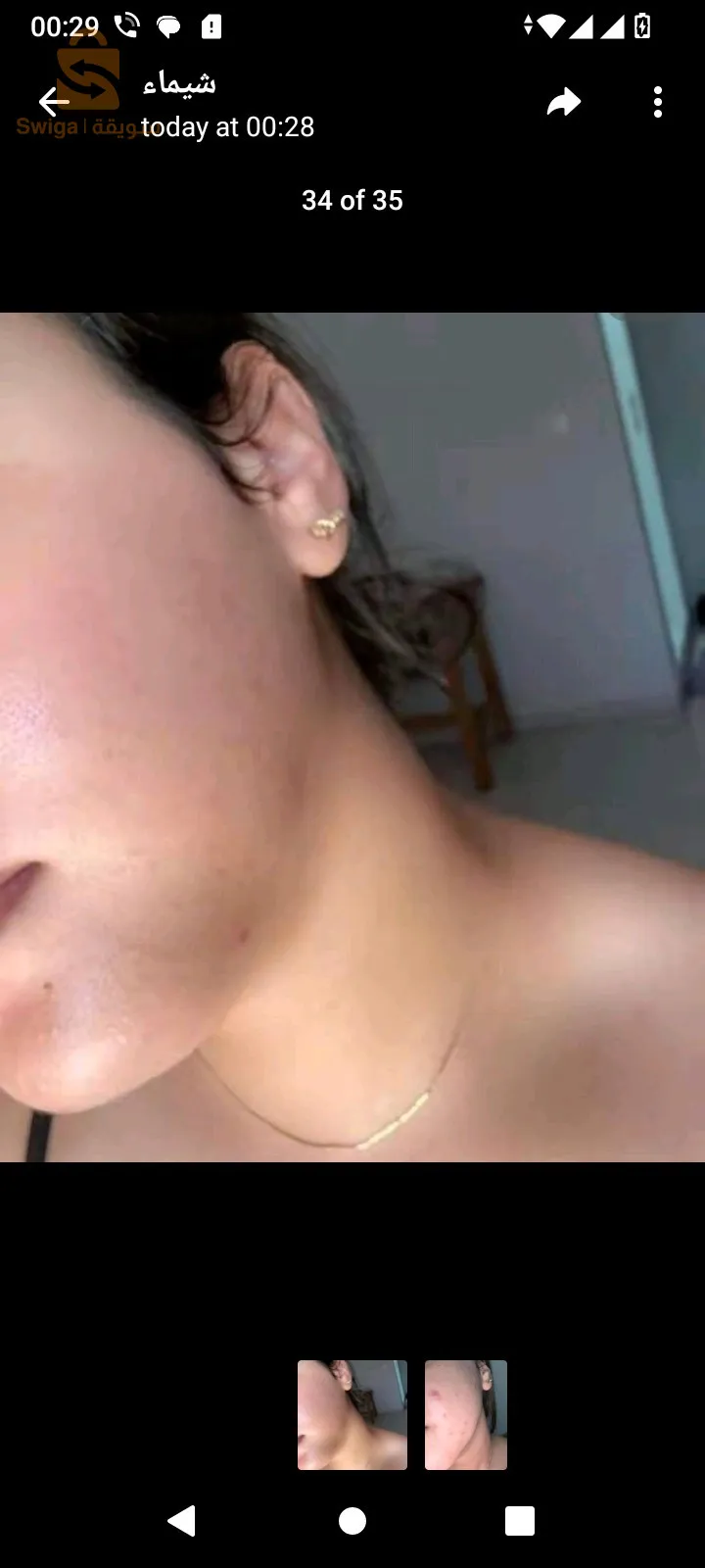 وصفة لقضاء على حب شباب