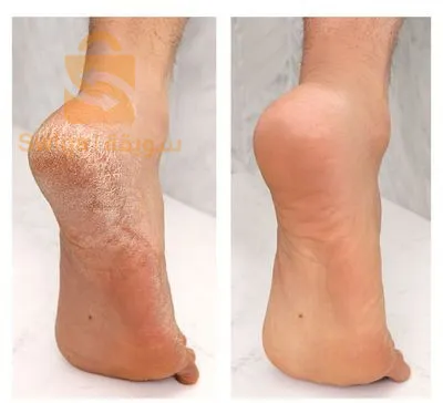 Avec ce produit, dites adieu aux pieds gercés 🦶🏻💧🪄