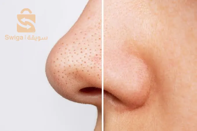 الحل النهائي لمشاكل الرؤوس السوداء للبشرة الدهنية و المختلطة و العادية👏🏻🌵🥭