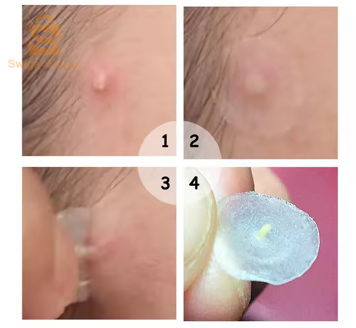 BREYLEE.  masque transparent anti acné à usage nocturne