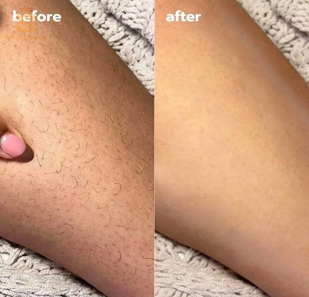 جهاز ازالة الشعر بتقنية IPL