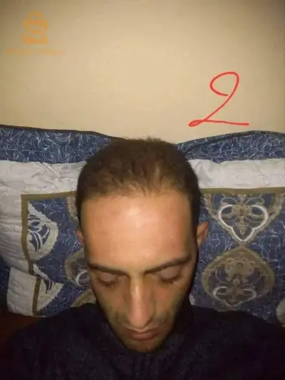 منتوج طبيعي 100% لتقوية الشعر والحد من تساقطه في وقت وجيز