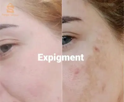 expigment 4% original