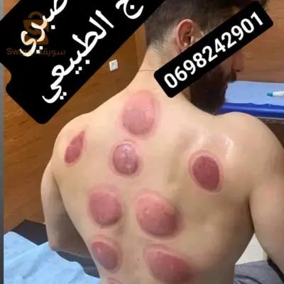 حجامة وقائية لممارس رياضة كمال الاجسام