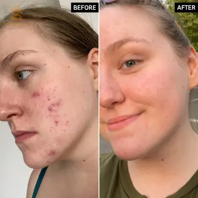 The ordinary Glycolic acid 7%🥰