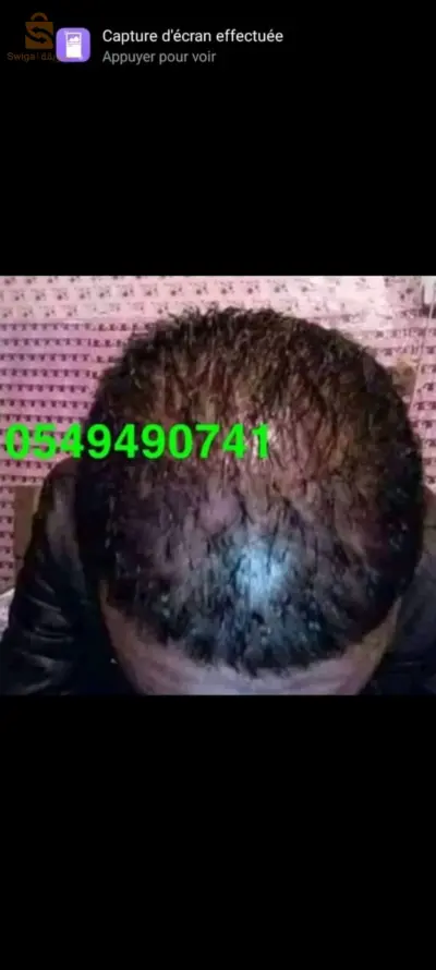الزيت السحري لتنبيت الشعر وملء الفراغات غني بالفيتامينات والبروتينات التي تحتاج لها فروه الراس