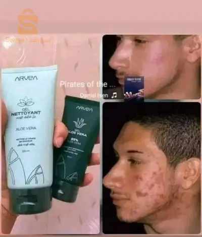 الحل لحب الشباب و ثفاء الوجه