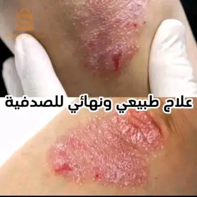 علاج الصدفية